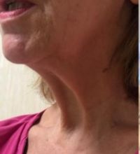 Prima e dopo - Lifting del collo preoperatorio